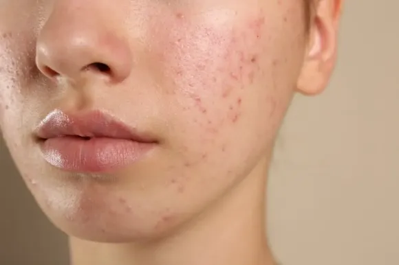 Phục Hồi Da Sau Peel, Laser, Treatment: Những Điều Bắt Buộc Phải Biết
